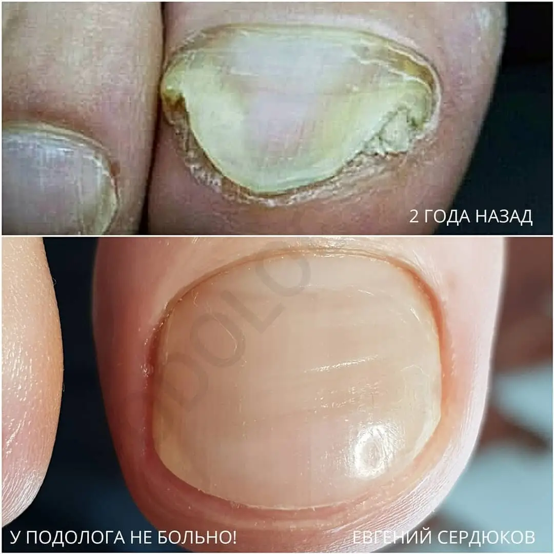 Onychomycosis (nail fungus)